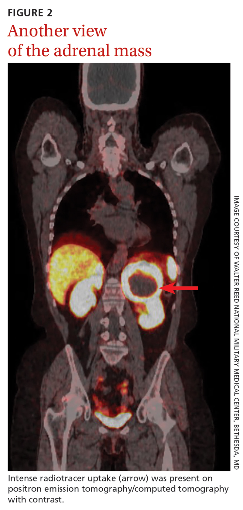 Another view of the adrenal mass