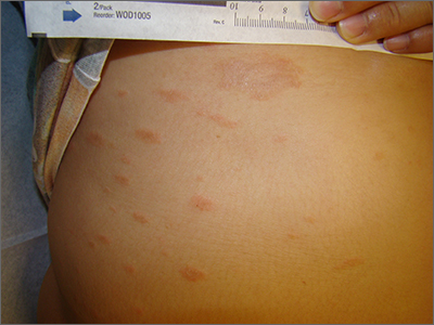 Persistent scaling rash