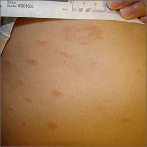 Persistent scaling rash