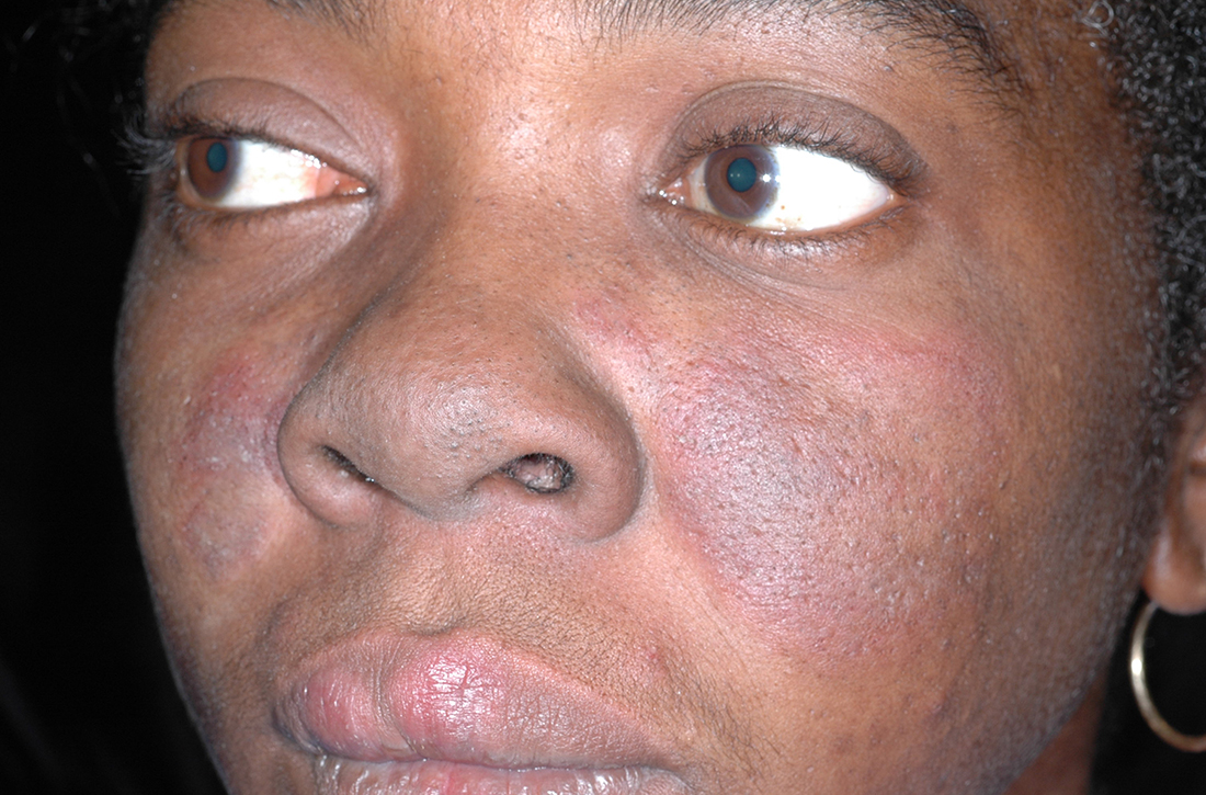 A Black woman with malar erythema and hyperpigmentation from acute cutaneous lupus erythematosus. The nasolabial folds are spared.