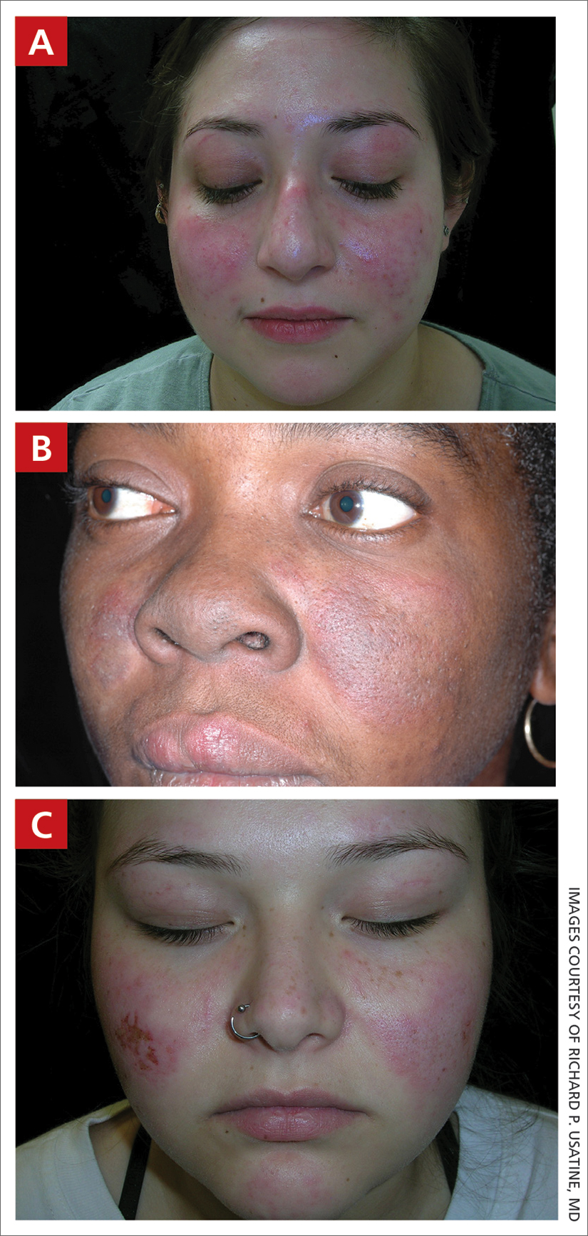 Systemic Lupus Erythematosus MDedge Family Medicine