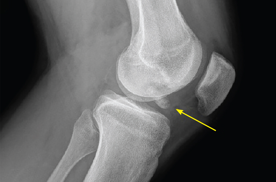 Unstable and displaced osteochondral lesion