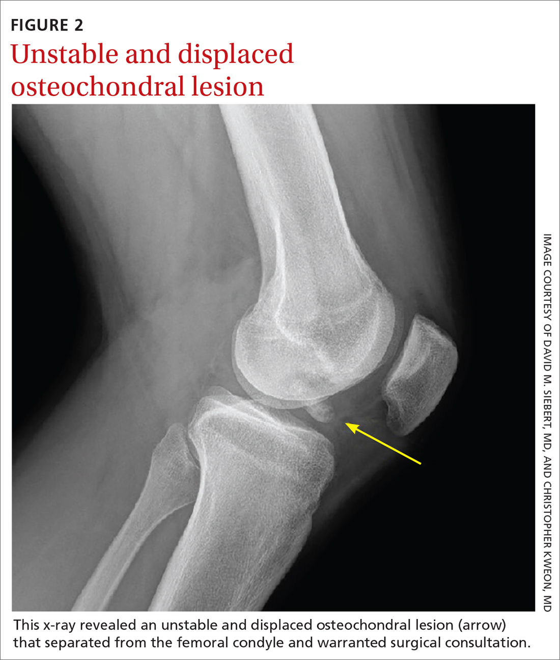 Unstable and displaced osteochondral lesion