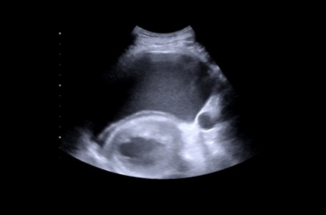 Bedside lung ultrasound revealed pleural effusion in both lungs