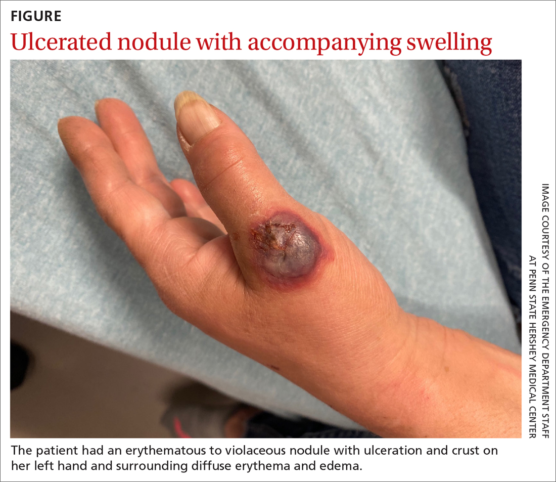 Ulcerated nodule with accompanying swelling