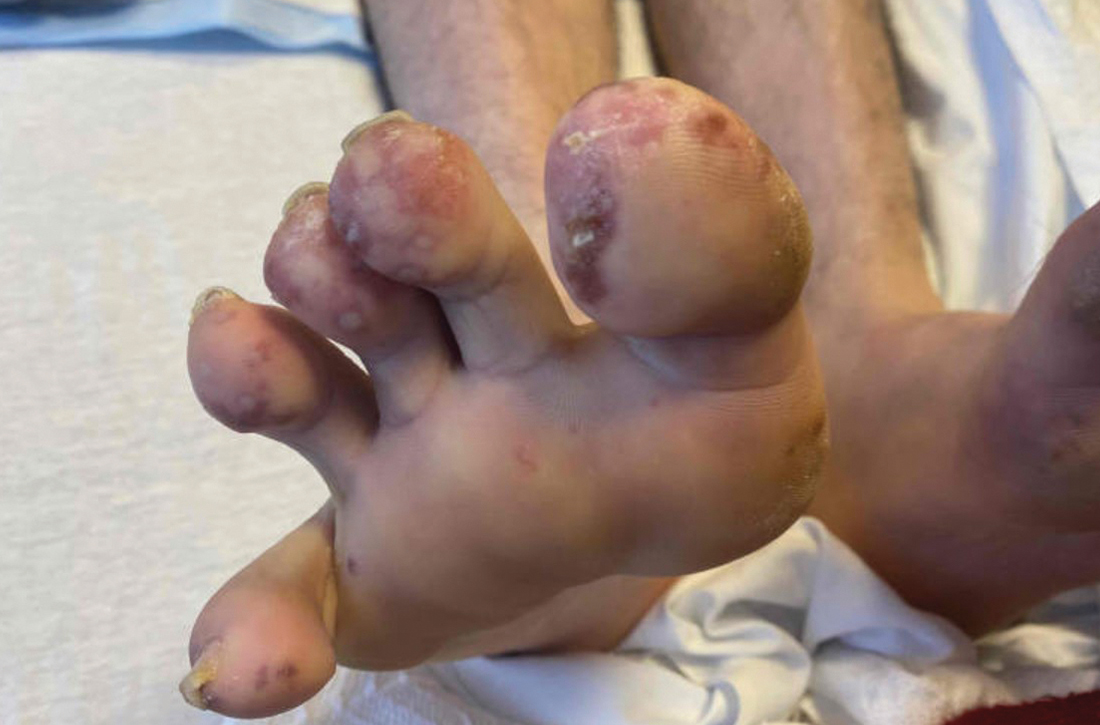 Painful lesions on toes