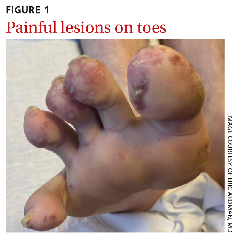 Painful lesions on toes