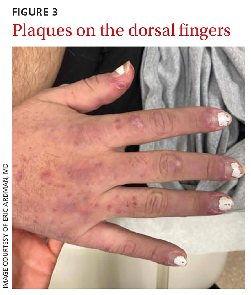 Plaques on the dorsal fingers