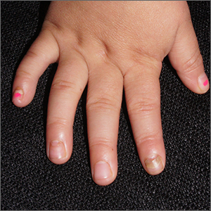 Nails falling off in a 3-year-old