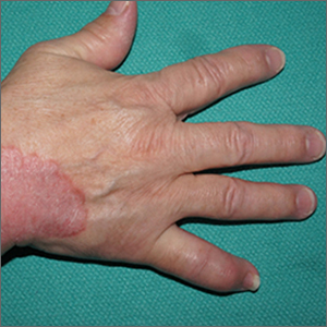 Focal plaques and finger swelling