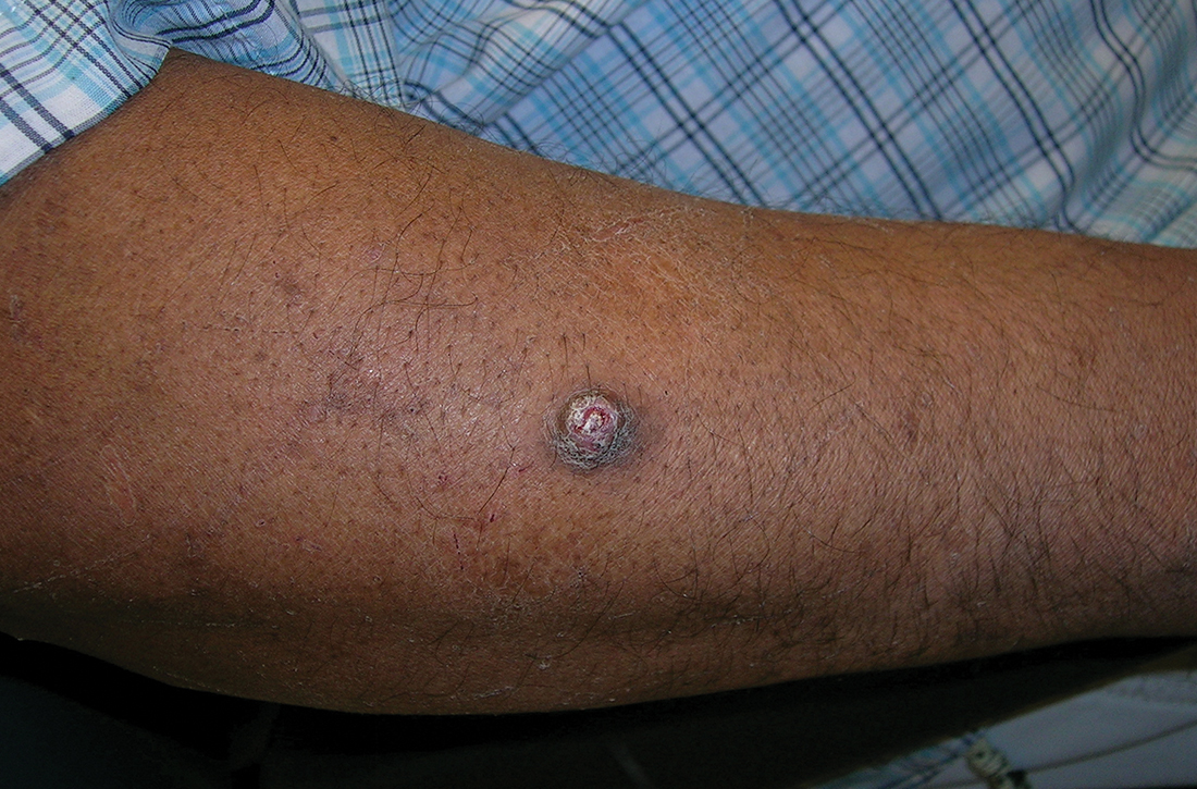 A 51-year-old Hispanic man with a squamous cell carcinoma (SCC) of the keratoacanthoma type on the arm.