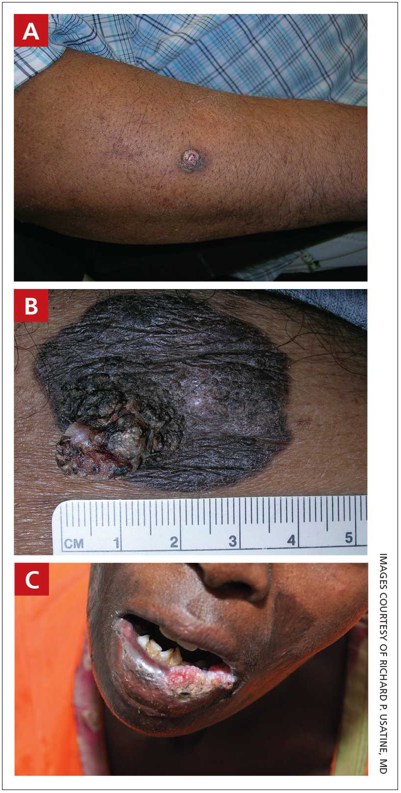 A 51-year-old Hispanic man with a squamous cell carcinoma (SCC) of the keratoacanthoma type on the arm.