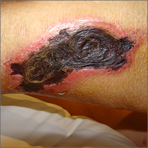 Leathery plaque on thigh