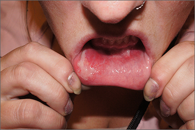 Inner lip erosions