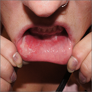 Inner lip erosions