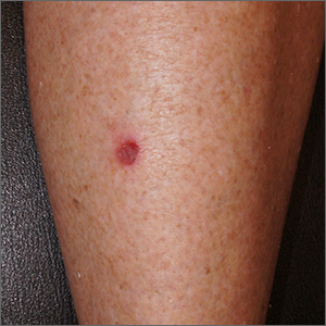 Small persistent leg wound