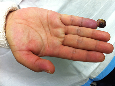 Painful fingertip tumor in pregnancy