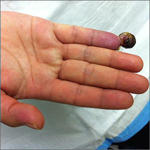 Painful fingertip tumor in pregnancy