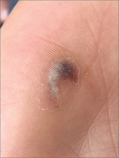 Hyperpigmented lesion on palm