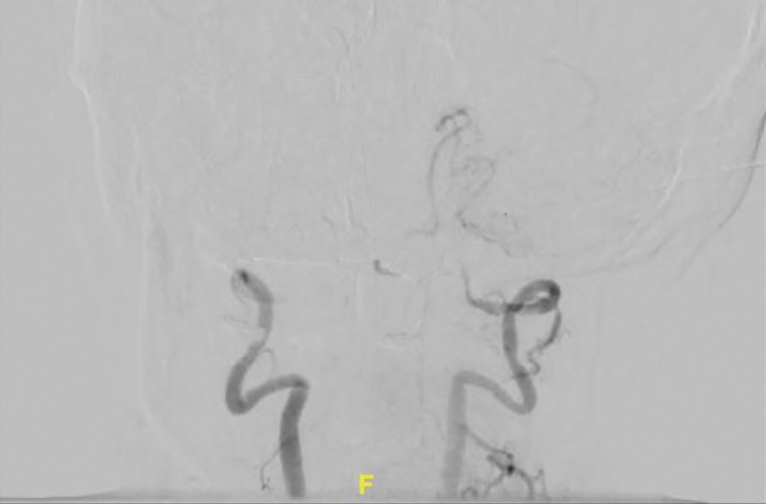 Simultaneous contrast injection of both vertebral arteries before thrombectomy showed occlusion of the intracranial vertebral arteries bilaterally with contrast opacification of the left posterior inferior cerebellar artery only (arrow).