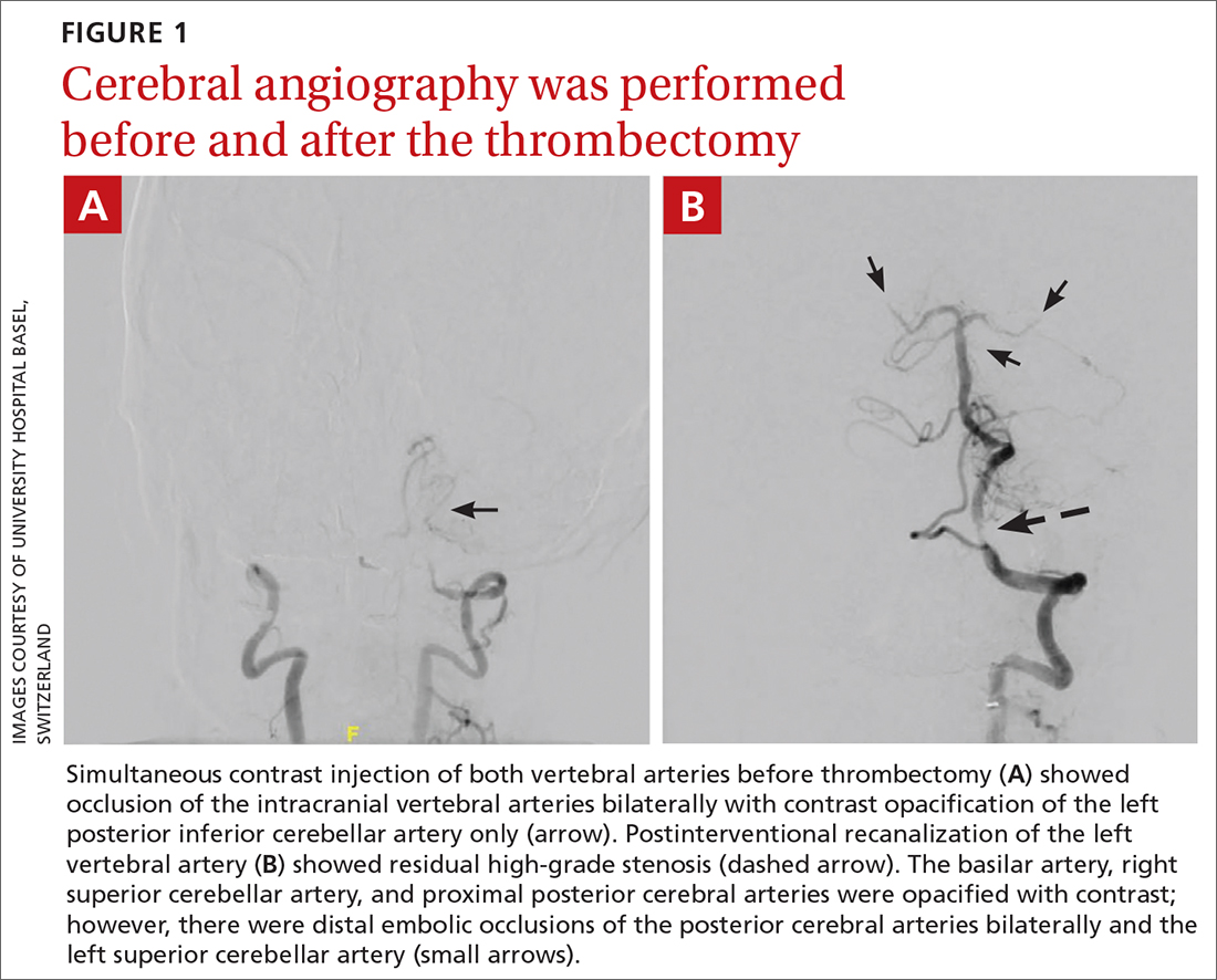 Cerebral angiography was performed before and after the thrombectomy