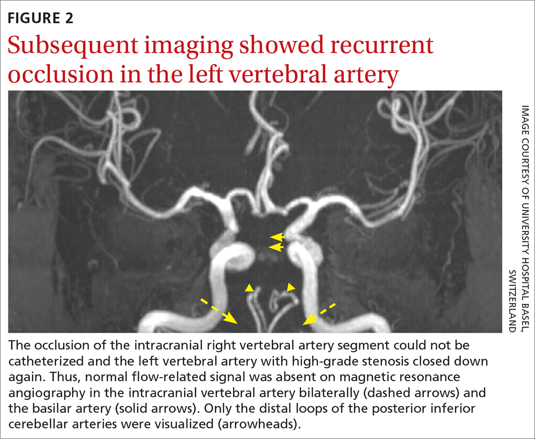 Subsequent imaging showed recurrent occlusion in the left vertebral artery 