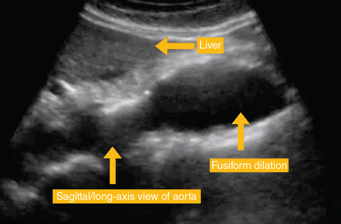 Fusiform vs saccular aneurysms: How they look 