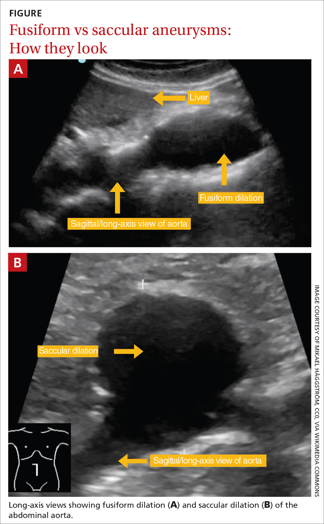 Fusiform vs saccular aneurysms: How they look