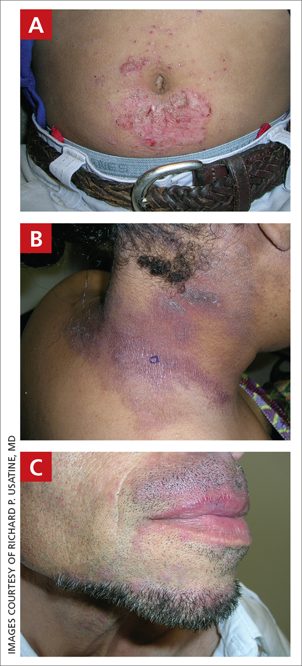 An 11-year-old Hispanic boy with allergic contact dermatitis (ACD) on the abdomen. The geometric nature of the eruption and proximity to the belt buckle were highly suggestive of ACD to nickel; patch testing was not needed.