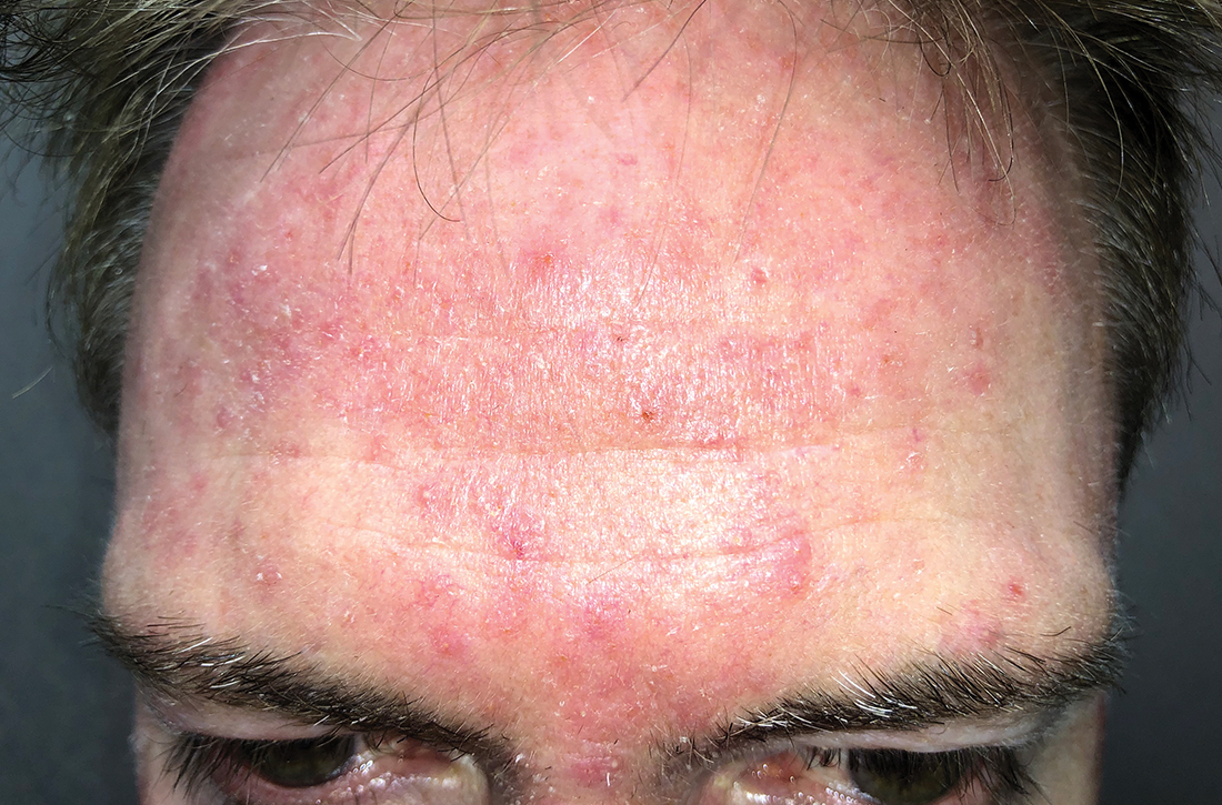 Erythematous papules and pustules on the face