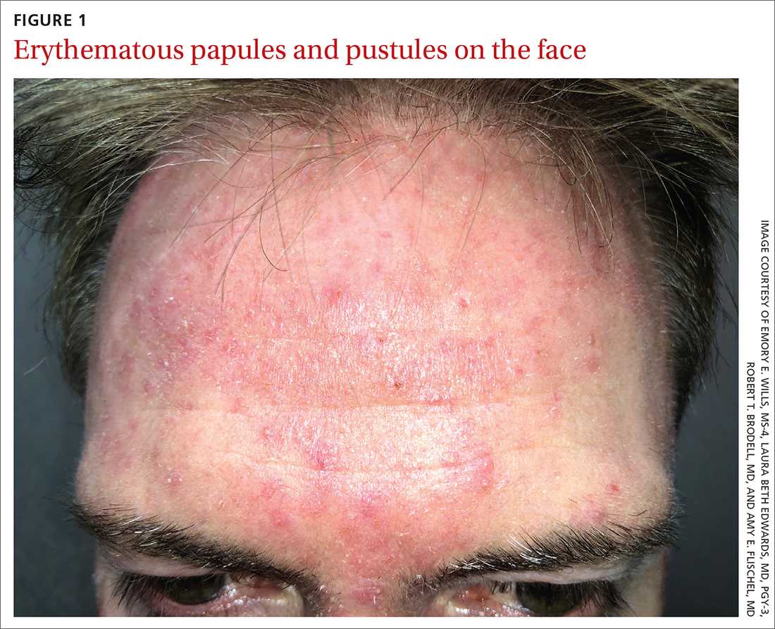 Erythematous papules and pustules on the face