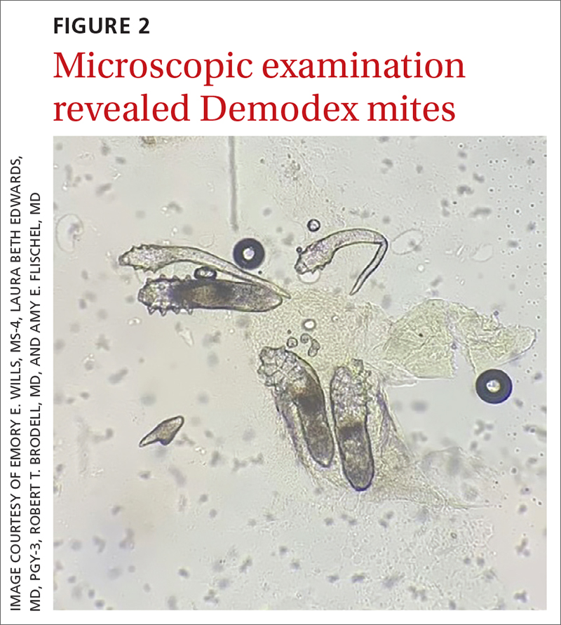 Microscopic examination revealed Demodex mites