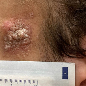 Enlarging lesion on temple 