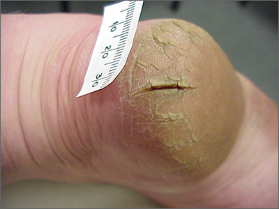 Severe cracked heel balm-anti chafe stick