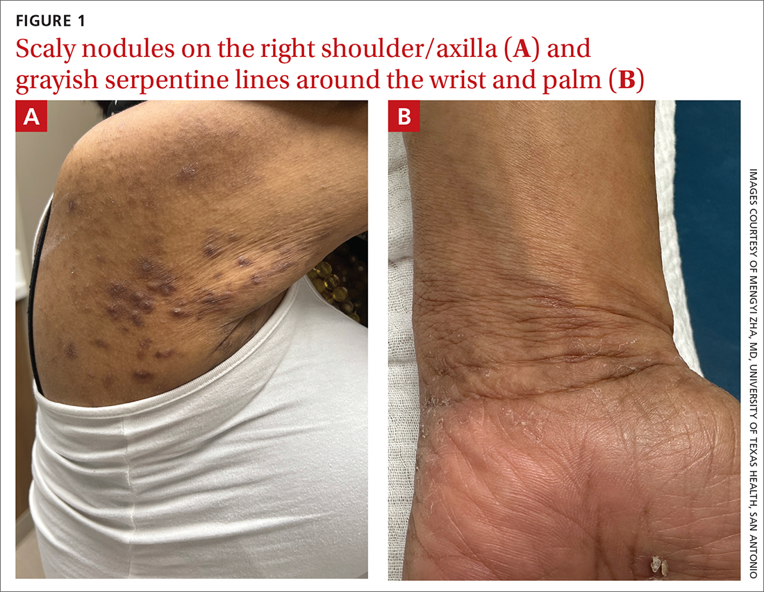 Scaly nodules on the right shoulder/axilla (A) and grayish serpentine lines around the wrist and palm (B)