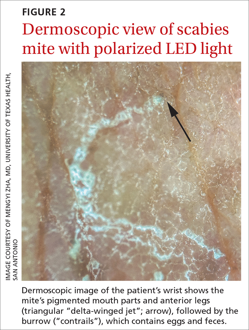 Dermoscopic view of scabies mite with polarized LED light