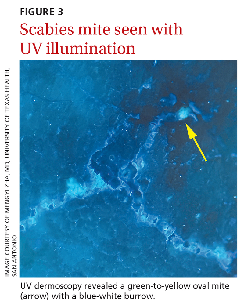 Scabies mite seen with UV illumination