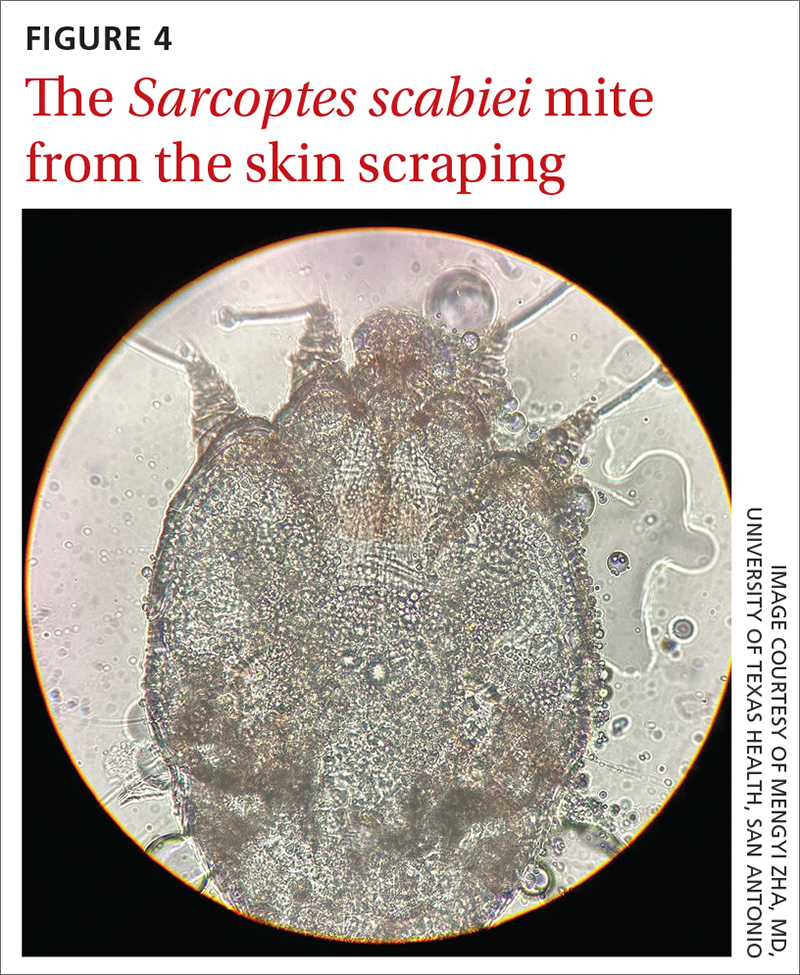 The Sarcoptes scabiei mite from the skin scraping