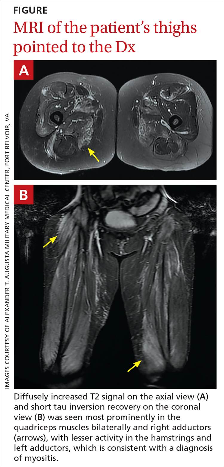 MRI of the patient’s thighs pointed to the Dx