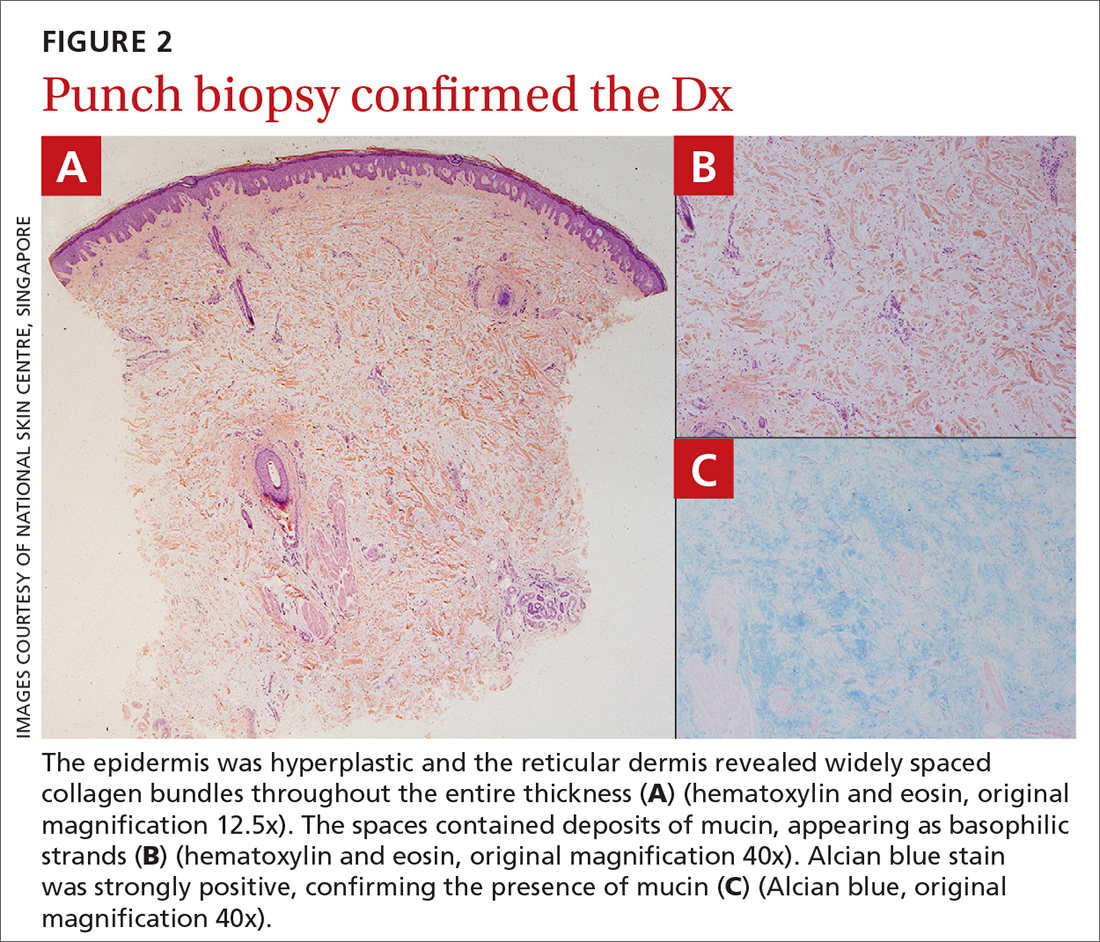 Punch biopsy confirmed the Dx