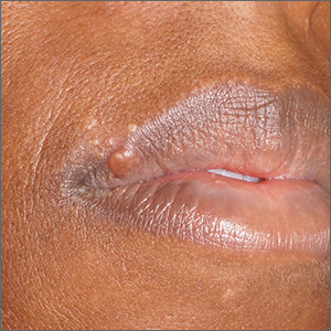 Papules on lip