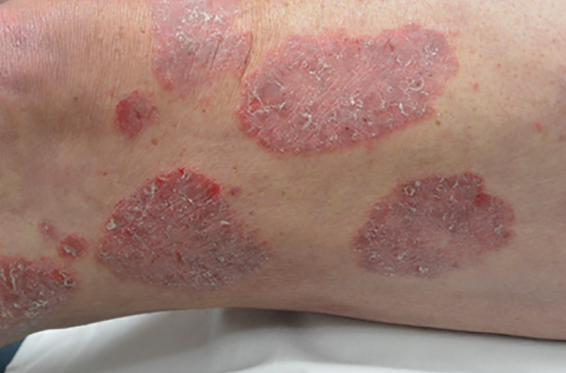 Plaque psoriasis