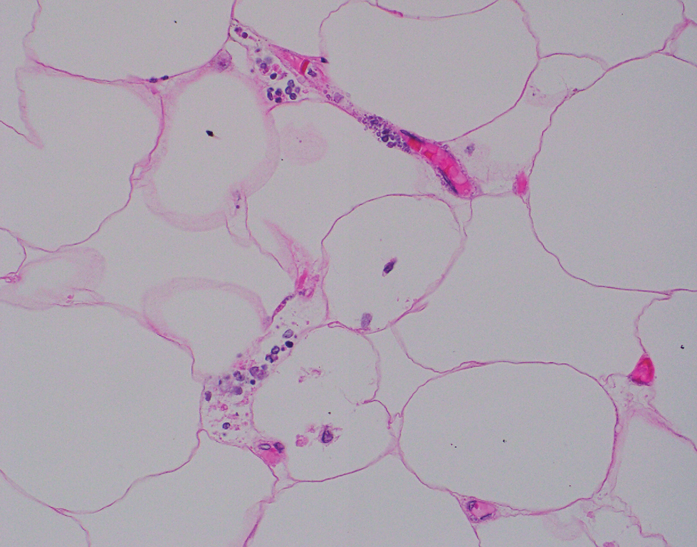 Tiny stippled calcium deposits within very small vascular lumina characteristic of calcific uremic arteriolopathy (H&E, original magnification ×400).