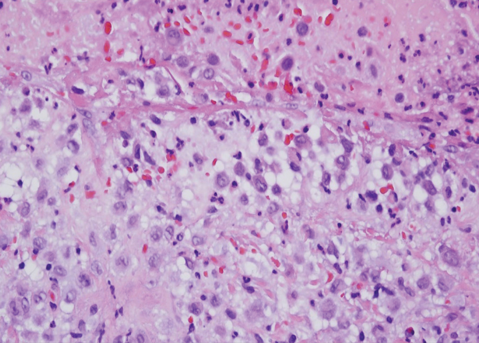 In Langerhans cell histiocytosis, Langerhans cells have a characteristic eccentrically disposed, reniform nucleus with abundant eosinophilic cytoplasm and do not show any scavenger properties, as revealed by a lack of phagocytosis of cells or cell remnant