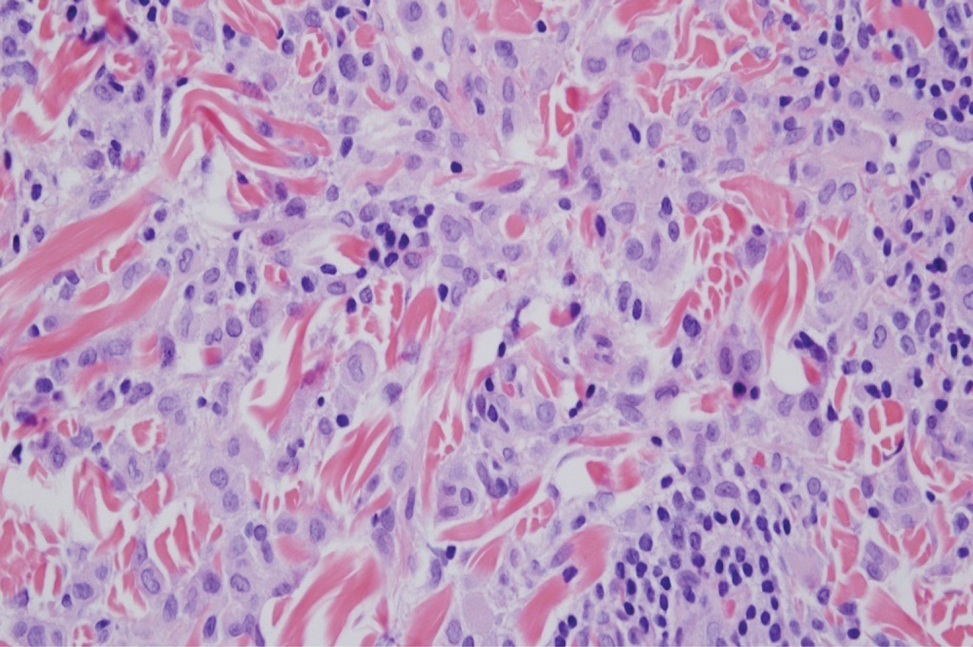 In indeterminate cell histiocytosis, the typical Langerhans cell cytomorphology demonstrates infiltrates that predominantly are dermal without notable epidermotropism