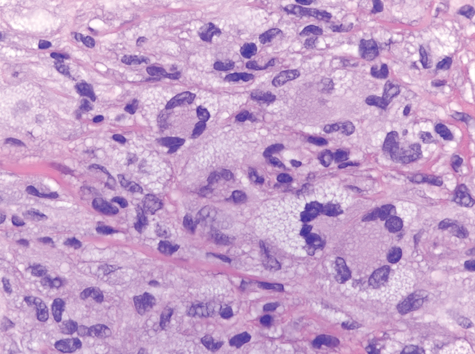 The Touton giant cell—a multinucleated histiocyte exhibiting a concentric wreathlike arrangement of nuclei with accompanying peripheral lipidization—is a characteristic hallmark cell encountered in xanthogranuloma