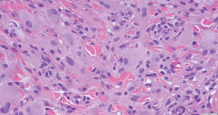 Large histiocytoid cells of reticulohistiocytoma with abundant eosinophilic to amphophilic cytoplasms, with a few of the neoplastic cellular elements exhibiting xanthomatous change