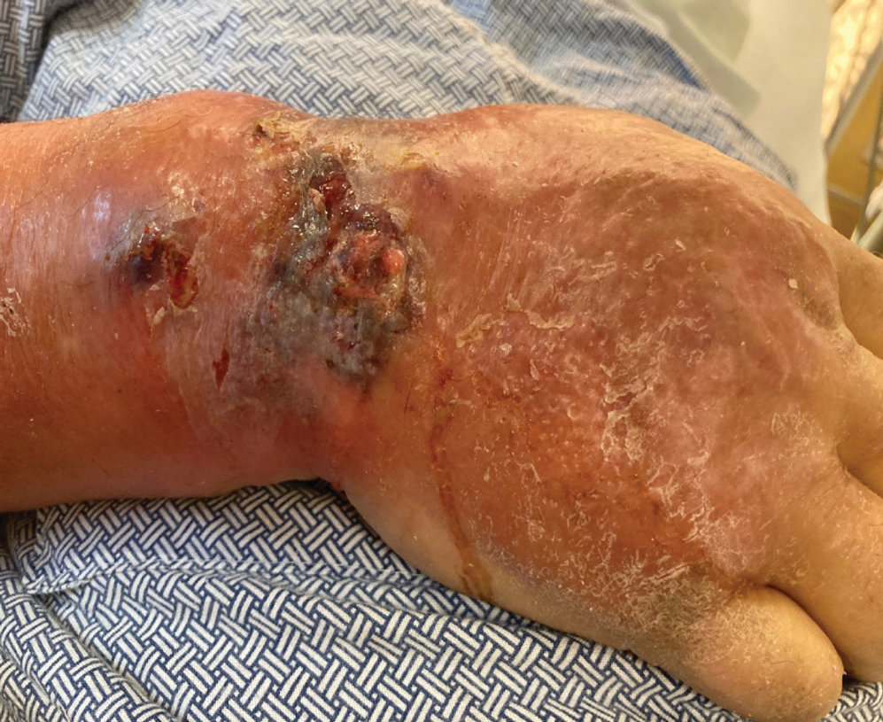 Necrotizing myositis of the right hand and forearm with diffuse redness, erythema, and edema surrounding a large necrotic ulceration with purulent debris.