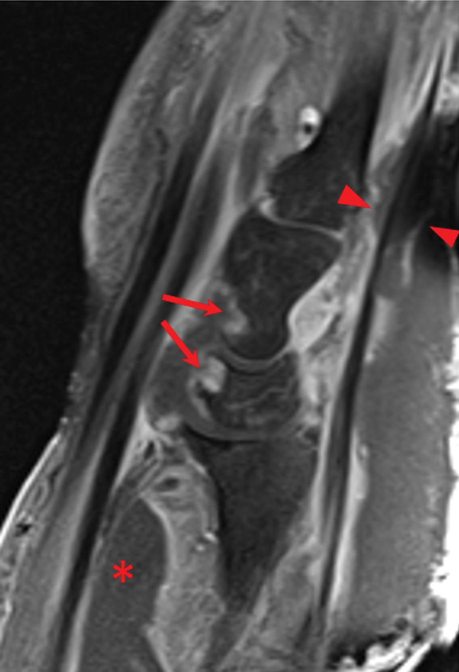 Sagittal view of T1-weighted, postcontrast, fat-saturated magnetic resonance imaging of necrotizing myositis of the wrist, demonstrating rim-enhanced intramuscular abscesses (asterisk), contrast-enhancing erosions of the carpus (arrows), and rim-enhancing