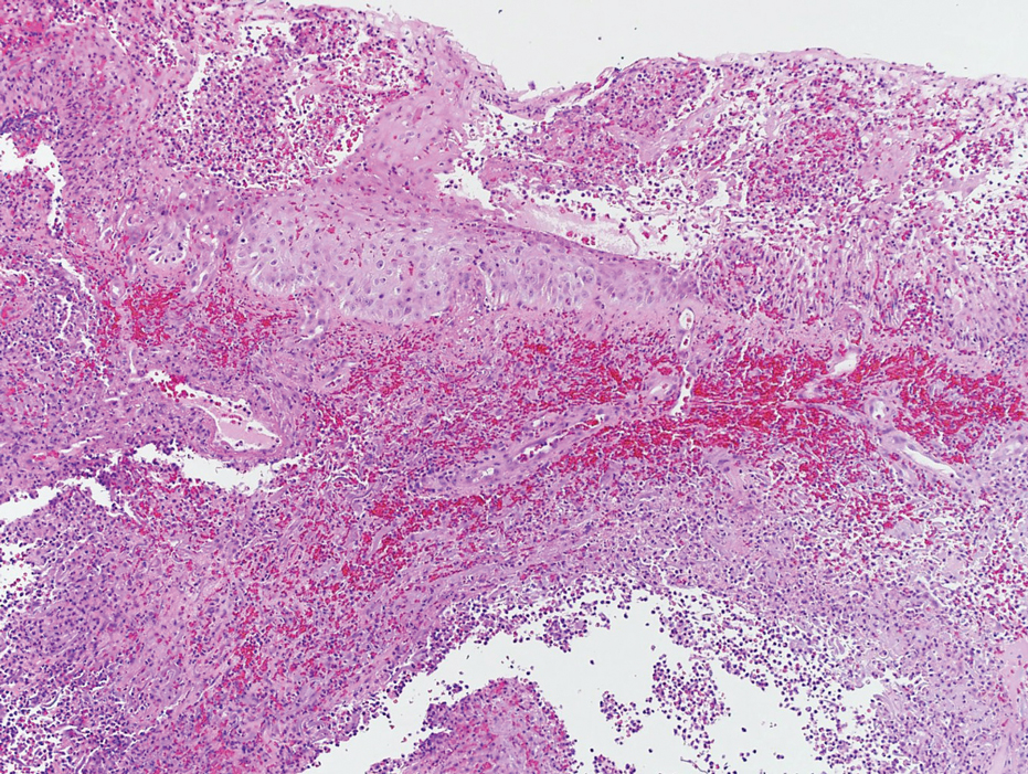 A biopsy specimen of the right wrist revealed a necrotic epidermis with neutrophilic pustules and a dense dermal infiltrate comprised of neutrophils that was characteristic of necrotizing myositis (H&E, original magnification ×100).